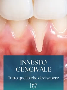 Elite Odontoiatrica - Innesto Gengivale