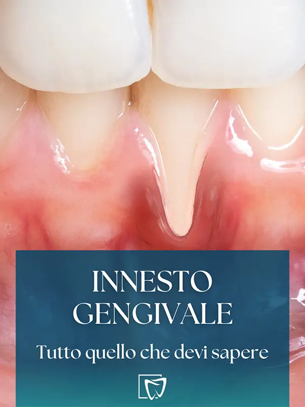 Elite Odontoiatrica - Innesto Gengivale